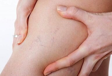амалҳои манъшударо барои рагҳои витритикӣ манъ кард